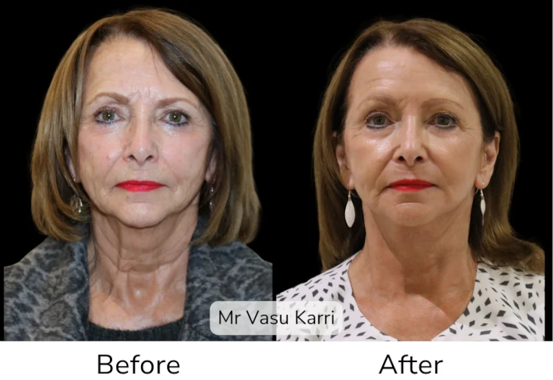 Facelift Patient 1 View 1